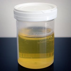 Urine sample in a collection container