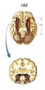 HM's brain after medial temporal lobe resection