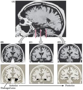 MRI showing extent of HM's brain damage