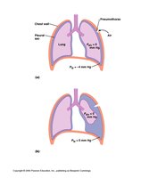 Diagram of pneumothorax showing air in pleural space and collapsed lung