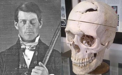 Phineas Gage and his skull