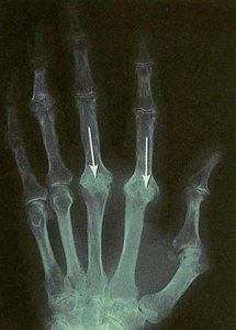 X-ray showing osteoarthritis in hand joints