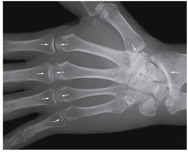 Epiphyseal lines in an adult's hand