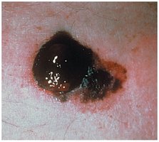 Malignant melanoma