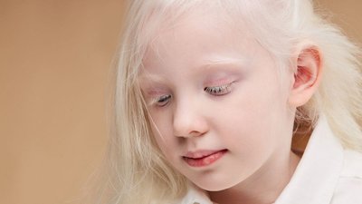 Clinical image of albinism