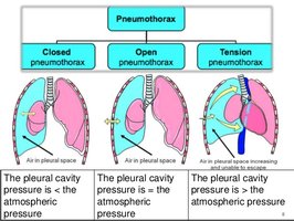 Types of pneumothorax and pleural cavity pressure