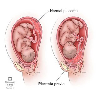 Normal placenta vs placenta previa