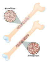 Normal bone vs osteoporosis