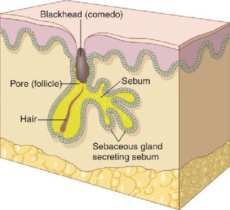 Acne: papular and pustular eruption with blackhead
