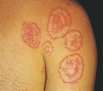 Tinea corporis: fungal infection of the skin