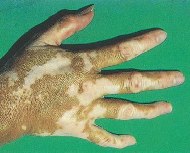 Vitiligo: loss of pigment in areas of the skin