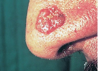 Basal cell carcinoma: malignant tumor of basal cell layer