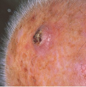 Squamous cell carcinoma: malignant tumor of squamous cells