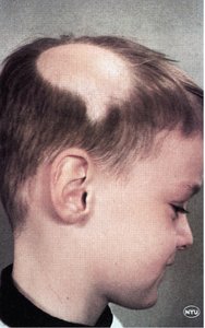 Alopecia: absence of hair on scalp