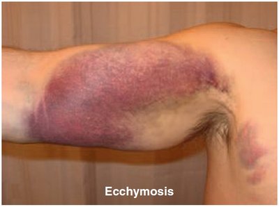 Ecchymosis: blue-purple marks on the skin