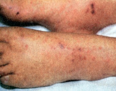 Petechia: small pinpoint hemorrhages on the skin
