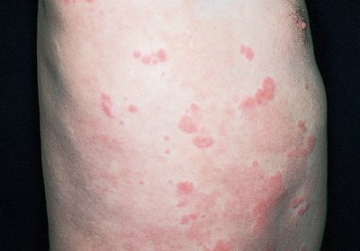 Urticaria: red, round wheals on the skin