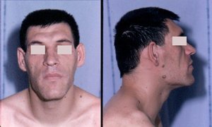 Pituitary dwarfism due to GH hyposecretion