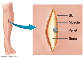 Describing a wound in the crural region