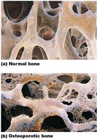 Normal vs osteoporotic bone architecture