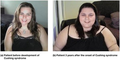 Cushing syndrome patient before and after onset