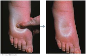 Pitting edema