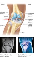 Knee injuries and the unhappy triad