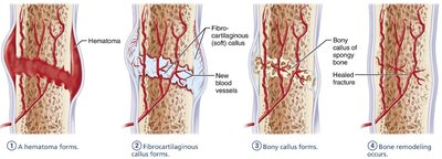 Stages of bone repair