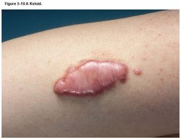 Keloid scar