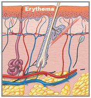 First-degree burn (erythema)