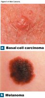 Basal cell carcinoma and melanoma
