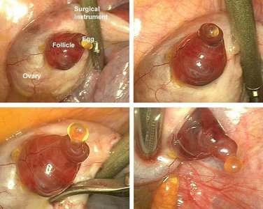 Photograph of ovulation: follicle rupture and egg release