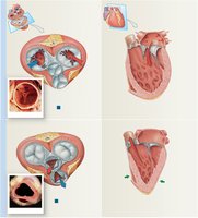 Valves of the Heart