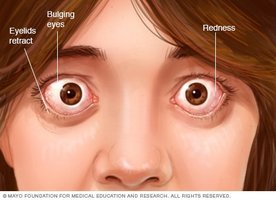 Exophthalmia in hyperthyroidism
