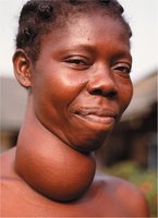 Goiter in thyroid disorder
