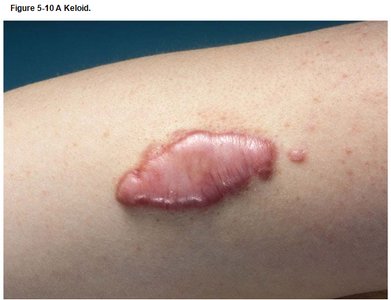 A keloid scar