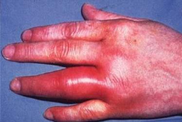 Inflamed hand