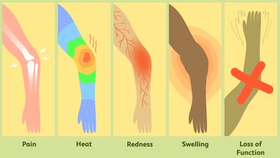 Five cardinal signs of inflammation