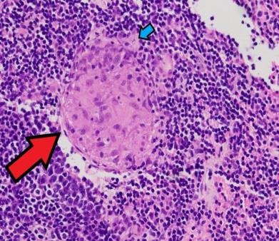 Granuloma formation in tissue