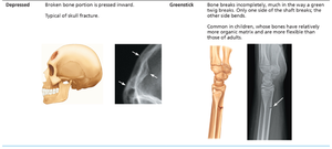Depressed and greenstick fractures