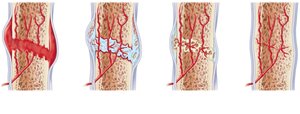 Stages in the healing of bone fracture