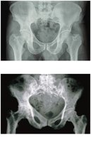 Normal bone vs. Pagetic bone