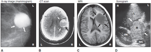Medical images of tumors: X-ray, CT, MRI, and sonogram