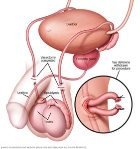 Vasectomy procedure diagram