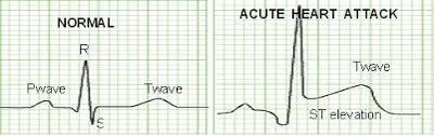 Normal and acute heart attack ECG