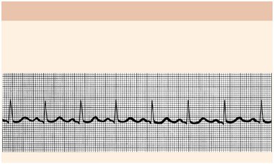 Normal sinus rhythm ECG