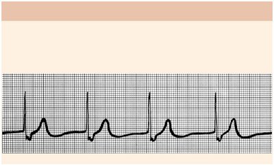 Junctional rhythm ECG