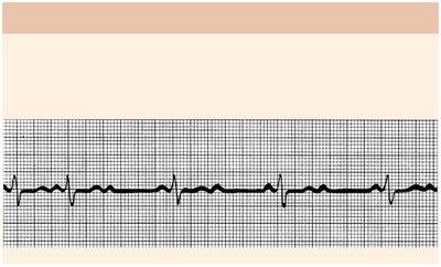 Second-degree heart block ECG
