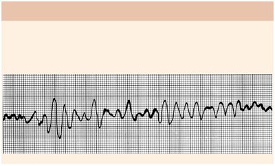 Ventricular fibrillation ECG
