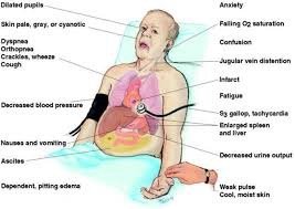 Congestive heart failure symptoms